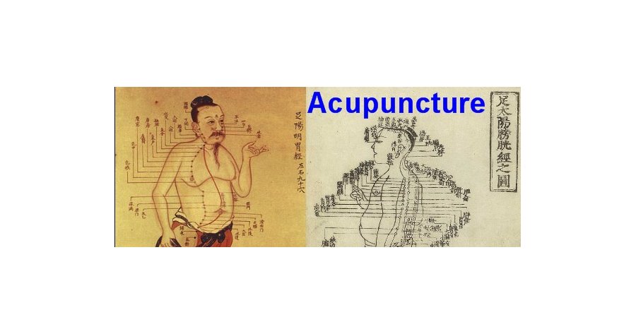 L'acupuncture autour de la naissance : bases scientifiques et états des  lieux